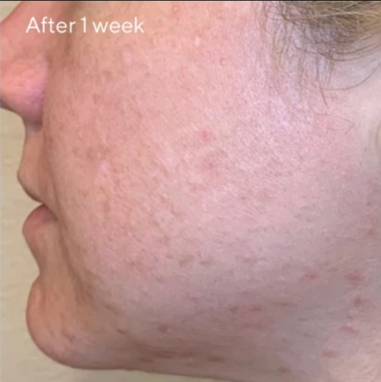 AHABHARetinoid_Daily_Clarifying_Peel_after