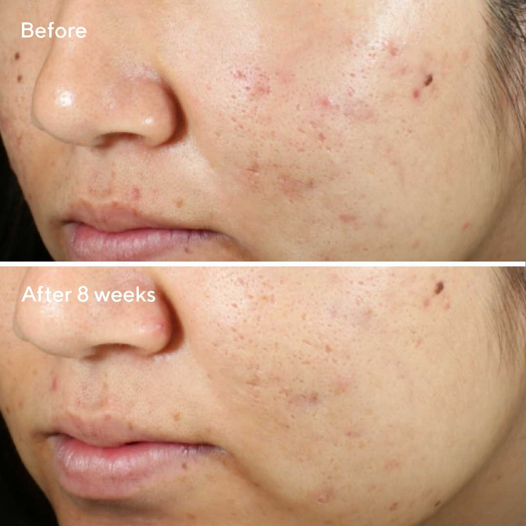 InvisiScar Resurfacing Treatment